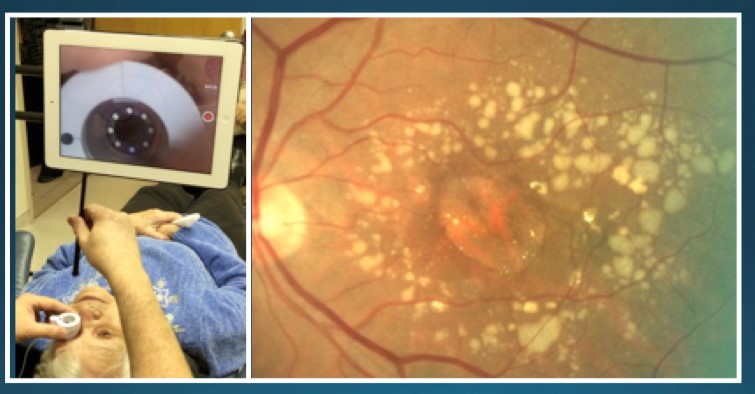 Two images side by side. In the first, a patient lying on her back receives a laser eye treatment for low-vision. The second image is of a retina.  