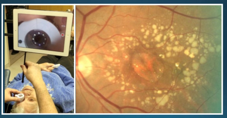 Two images side by side. In the first, a patient lying on her back receives a laser eye treatment for low-vision. The second image is of a retina.