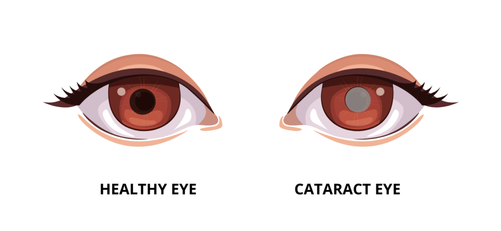 visual representation of a healthy eye versus an eye with cataract.