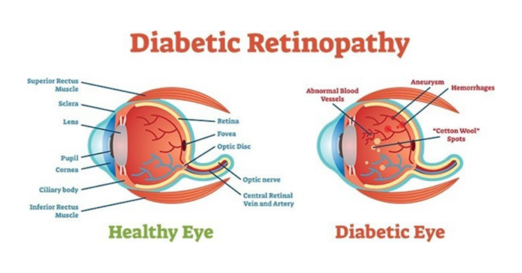 The image is a chart of diabetic retinopathy that displays the medical parts of an eye and the affects of diabetes on the eye