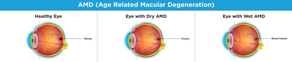 Image is of a detailed exploration of eyes with AMD