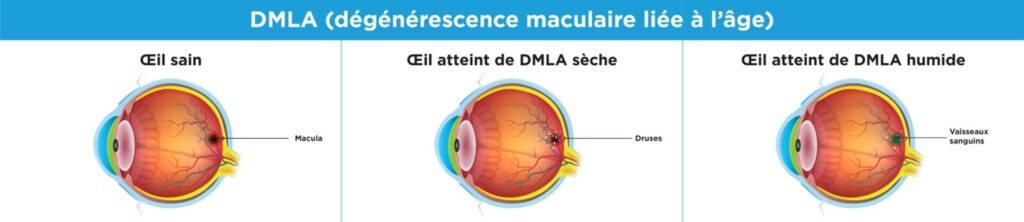 L'image montre une coupe transversale de trois globes oculaires : un normal, un atteint de DMLA sèche et un atteint de DMLA humide.